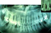 歯周病で退縮した歯槽骨